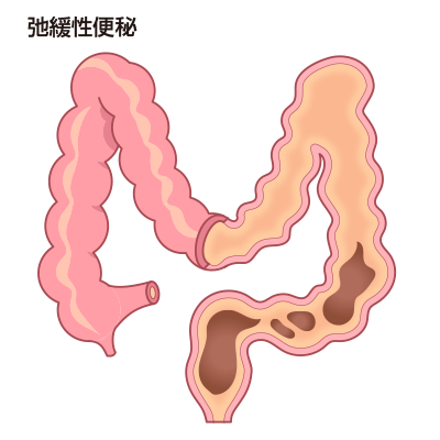 大腸の運動低下